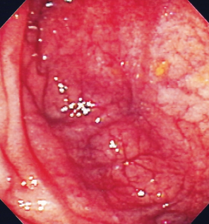 Ταυτοσκοπικές εικόνες υγιών ειλεϊκών ταυτών (Ευγενική παραχώρηση Dr. V. Penopoulos)