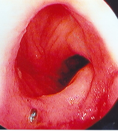 Ταυτοσκοπικές εικόνες υγιών ειλεϊκών ταυτών (Ευγενική παραχώρηση Dr. V. Penopoulos)