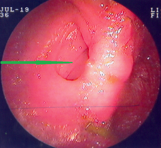 Πράσινο βέλος - Φυσιολογικό τυφλό άκρο ειλεϊκής ταύτης (Ευγενική παραχώρηση Dr. V. Penopoulos)