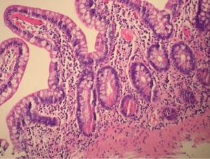 Μετεγχειρητικές βιοψίες ειλεϊκής ταύτης - Προσαρμογή ταύτης (Ευγενική παραχώρηση Dr. V. Penopoulos)