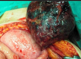 Διεγχειρητική στρέψη τυφλού (Ευγενική παραχώρηση Dr. V. Penopoulos)