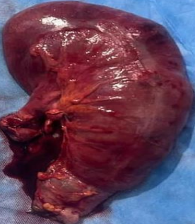 Χειρουργικό παρασκεύασμα δεξιάς ημικολεκτομής (Ευγενική παραχώρηση Dr. V. Penopoulos)