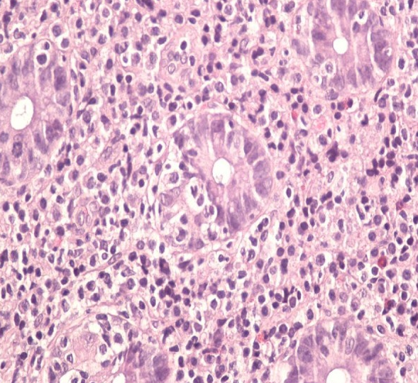 Ιστοπαθολογική εξέταση - Λέμφωμα MALT τυφλού (Ευγενική παραχώρηση Dr. V. Penopoulos)