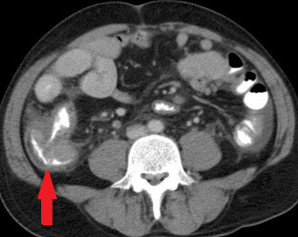 CT κοιλίας - MALToma τυφλού και παρακολικός λεμφαδένας (Ευγενική παραχώρηση Dr. V. Penopoulos)