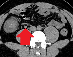 CT κοιλίας - MALToma τυφλού και παρακολικός λεμφαδένας (Ευγενική παραχώρηση Dr. V. Penopoulos)