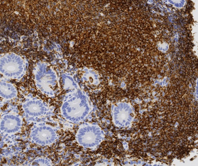 Εικόνα μακροσκοπικού παρασκευάσματος (Ευγενική παραχώρηση Dr. V. Penopoulos)