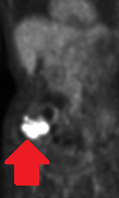 Εικόνα μακροσκοπικού παρασκευάσματος (Ευγενική παραχώρηση Dr. V. Penopoulos)