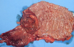 Εικόνα μακροσκοπικού παρασκευάσματος (Ευγενική παραχώρηση Dr. V. Penopoulos)