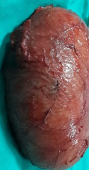 Μακροσκοπική εικόνα εκτομαθέντος κυστικού νεοπλάσματος (Ευγενική παραχώρηση Dr. V. Penopoulos)