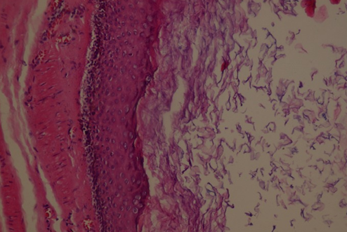 Ιστοπαθολογική εξέταση επιδερμοειδούς κύστης (Ευγενική παραχώρηση Dr. V. Penopoulos)