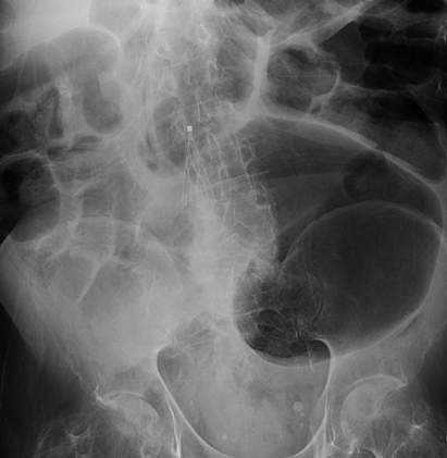 Παρασκεύασμα ορθοσιγμοειδεκτομής (Ευγενική παραχώρηση Dr. V. Penopoulos)