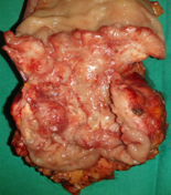 Ιστοπαθολογική εικόνα βλαβών συνδρόμου Sweet (Ευγενική παραχώρηση Dr. V. Penopoulos)