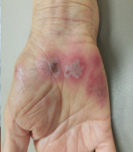 Ιστοπαθολογική εικόνα βλαβών συνδρόμου Sweet (Ευγενική παραχώρηση Dr. V. Penopoulos)