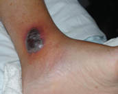 Ιστοπαθολογική εικόνα βλαβών συνδρόμου Sweet (Ευγενική παραχώρηση Dr. V. Penopoulos)