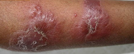 Ιστοπαθολογική εικόνα βλαβών συνδρόμου Sweet (Ευγενική παραχώρηση Dr. V. Penopoulos)