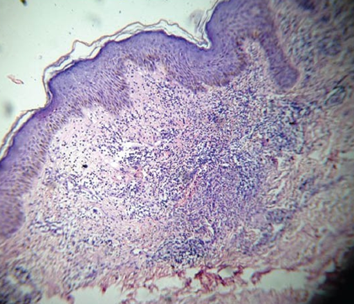 Ιστοπαθολογική εικόνα βλαβών συνδρόμου Sweet (Ευγενική παραχώρηση Dr. V. Penopoulos)