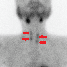 Total parathyroidectomy (Courtesy Dr. V. Penopoulos)