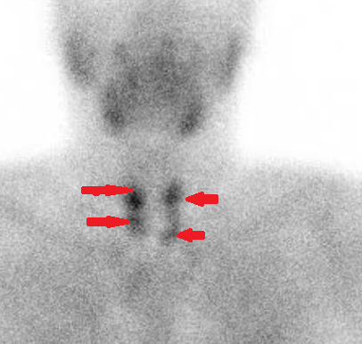 Total parathyroidectomy (Courtesy Dr. V. Penopoulos)