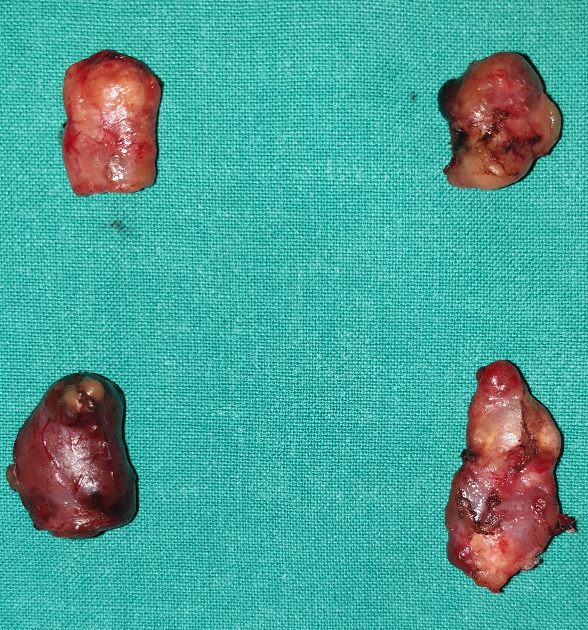 Total parathyroidectomy. Excision of a 5th ectopic parathyroid gland located in a left para-esophageal position (Courtesy Dr. V. Penopoulos)