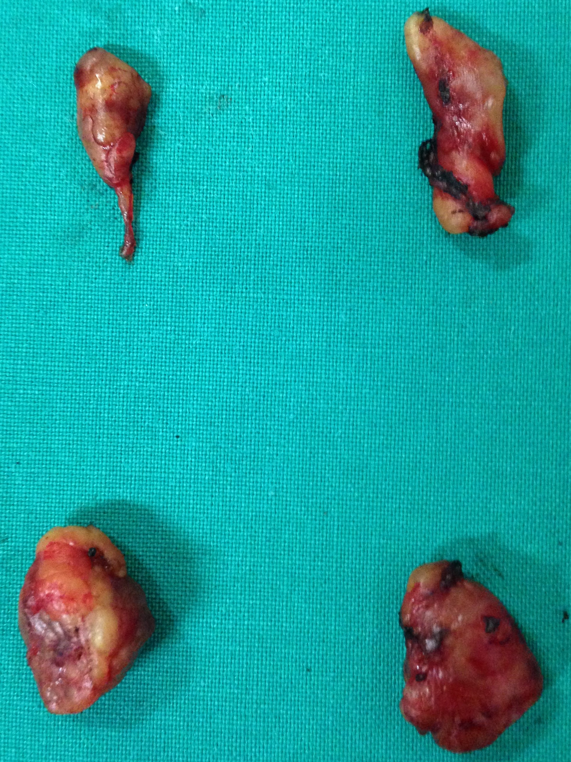 Autotransplantation of diffusely hyperplastic parathyroid tissue fragments into the right sternocleidomastoid muscle in two separately marked pockets (Courtesy Dr. V. Penopoulos)