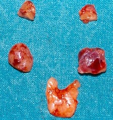Autotransplantation of diffusely hyperplastic parathyroid tissue fragments into the right sternocleidomastoid muscle in two separately marked pockets (Courtesy Dr. V. Penopoulos)