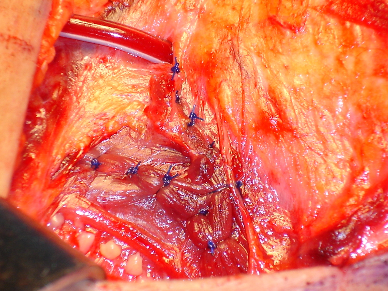 Autotransplantation of diffusely hyperplastic parathyroid tissue fragments into the right sternocleidomastoid muscle in two separately marked pockets (Courtesy Dr. V. Penopoulos)