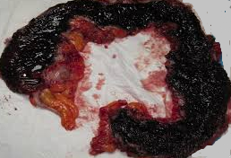 Παρασκεύασμα υποολικής κολεκτομής (Ευγενική παραχώρηση Dr. V. Penopoulos)