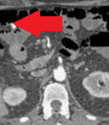Κόκκινο βέλος - Αιμορραγούσα εκκόλπωση εγκάρσιου κόλου (Ευγενική παραχώρηση Dr. V. Penopoulos)