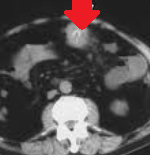 Αιμορραγούσες εκκολπώσεις (Ευγενική παραχώρηση Dr. V. Penopoulos)