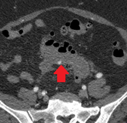 Παρασκεύασμα υποολικής κολεκτομής (Ευγενική παραχώρηση Dr. V. Penopoulos)