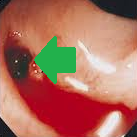 Παρασκεύασμα υποολικής κολεκτομής (Ευγενική παραχώρηση Dr. V. Penopoulos)