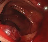 Παρασκεύασμα υποολικής κολεκτομής (Ευγενική παραχώρηση Dr. V. Penopoulos)