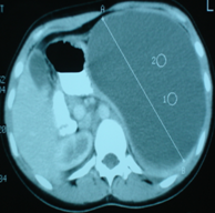 Intraoperative image following partial splenectomy (Courtesy Dr. V. Penopoulos)