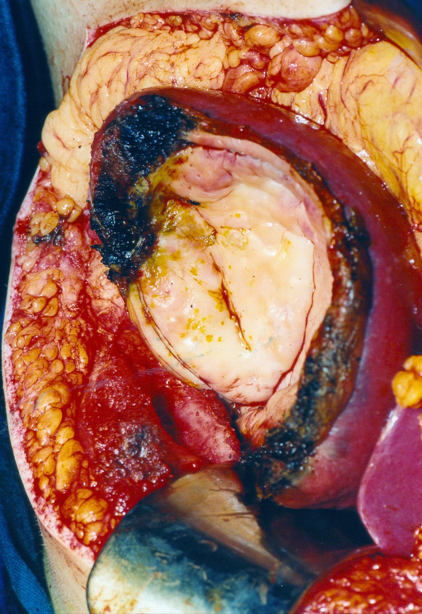Surgical specimen of simple splenic cyst removal by partial splenectomy (Courtesy Dr. V. Penopoulos)