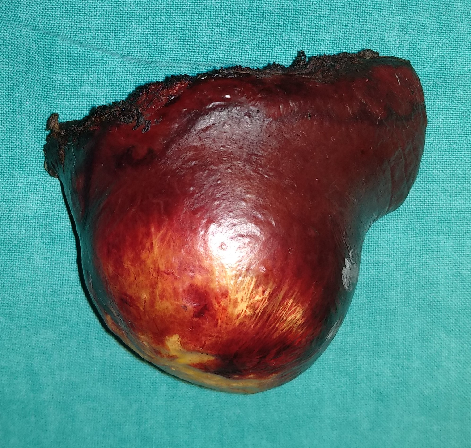 Multiloculated simple splenic cyst (Courtesy Dr. V. Penopoulos)