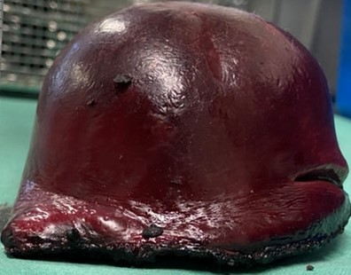 Epithelial splenic cyst. The trabeculated internal surface is visible, which may exhibit various types of epithelial lining (Courtesy Dr. V. Penopoulos)