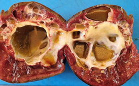 Epithelial splenic cyst. The trabeculated internal surface is visible, which may exhibit various types of epithelial lining (Courtesy Dr. V. Penopoulos)