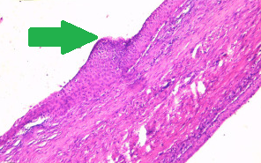 Epithelial splenic cyst. The trabeculated internal surface is visible, which may exhibit various types of epithelial lining (Courtesy Dr. V. Penopoulos)