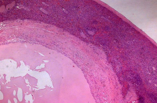 Epithelial splenic cyst. The trabeculated internal surface is visible, which may exhibit various types of epithelial lining (Courtesy Dr. V. Penopoulos)