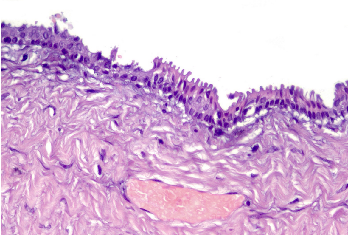 Epithelial splenic cyst. The trabeculated internal surface is visible, which may exhibit various types of epithelial lining (Courtesy Dr. V. Penopoulos)