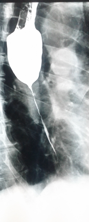 Gastrografin swallow - Colonojejunal anastomosis following esophagogastrectomy for extensive esophageal and gastric burns (Courtesy Dr. V. Penopoulos)