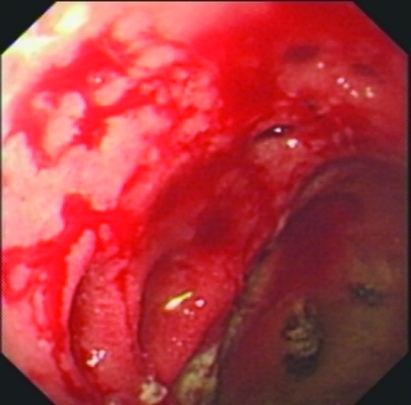 Gastrografin swallow - Esophagogastric anastomosis (stomach within the right hemithorax) (Courtesy Dr. V. Penopoulos)