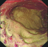 Esophagectomy - The endoprosthesis (stent) within the organ lumen is visible (Courtesy Dr. V. Penopoulos)