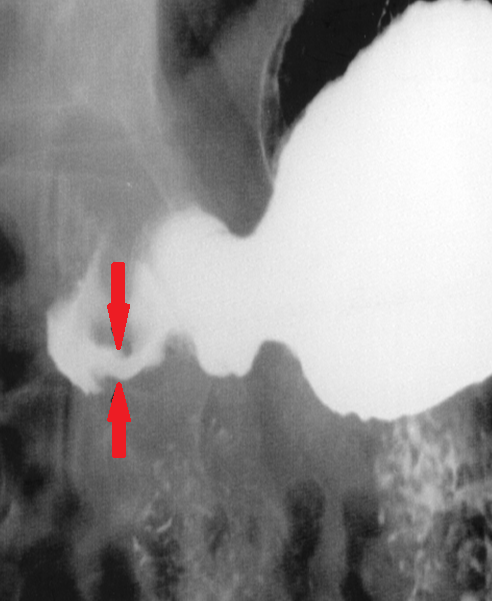 Postoperative stricture development at the esophagogastric anastomosis (Courtesy Dr. V. Penopoulos)