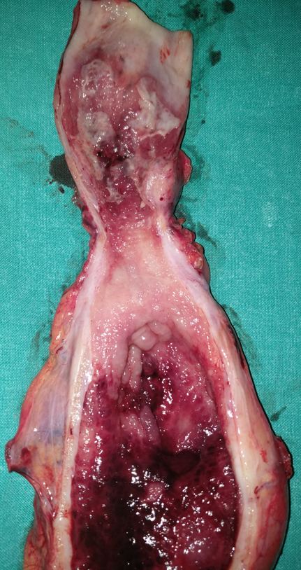 Postoperative stricture development at the esophagogastric anastomosis (Courtesy Dr. V. Penopoulos)