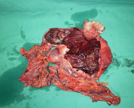 Postoperative stricture development at the esophagogastric anastomosis (Courtesy Dr. V. Penopoulos)