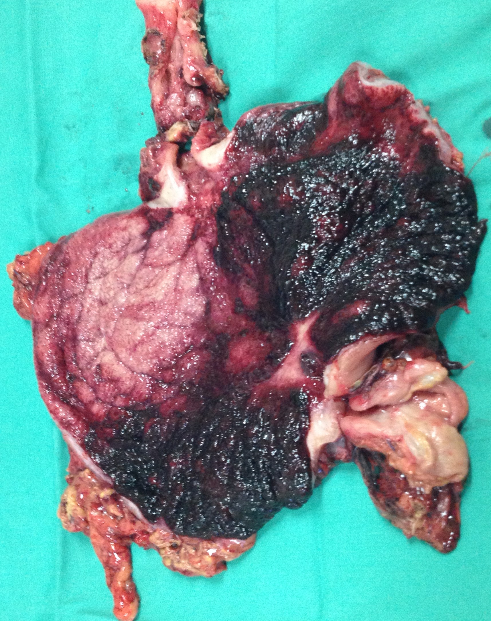 Postoperative stricture development at the esophagogastric anastomosis (Courtesy Dr. V. Penopoulos)