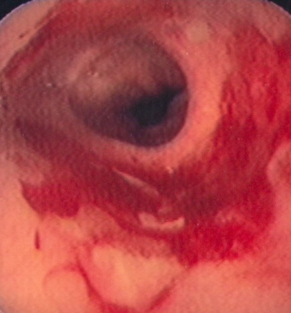 Postoperative stricture development at the esophagogastric anastomosis (Courtesy Dr. V. Penopoulos)