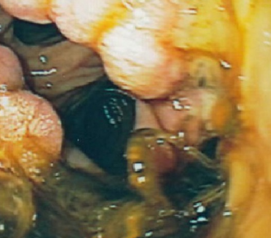 Postoperative stricture development at the esophagogastric anastomosis (Courtesy Dr. V. Penopoulos)