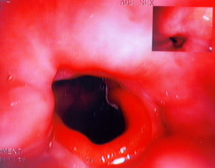 Postoperative stricture development at the esophagogastric anastomosis (Courtesy Dr. V. Penopoulos)